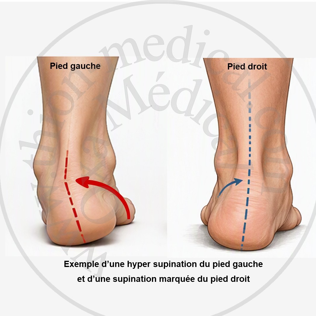 Schéma de l’hyper supination du pied